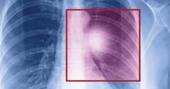 Groundbreaking Technique at the Quirón Quiron Cancer